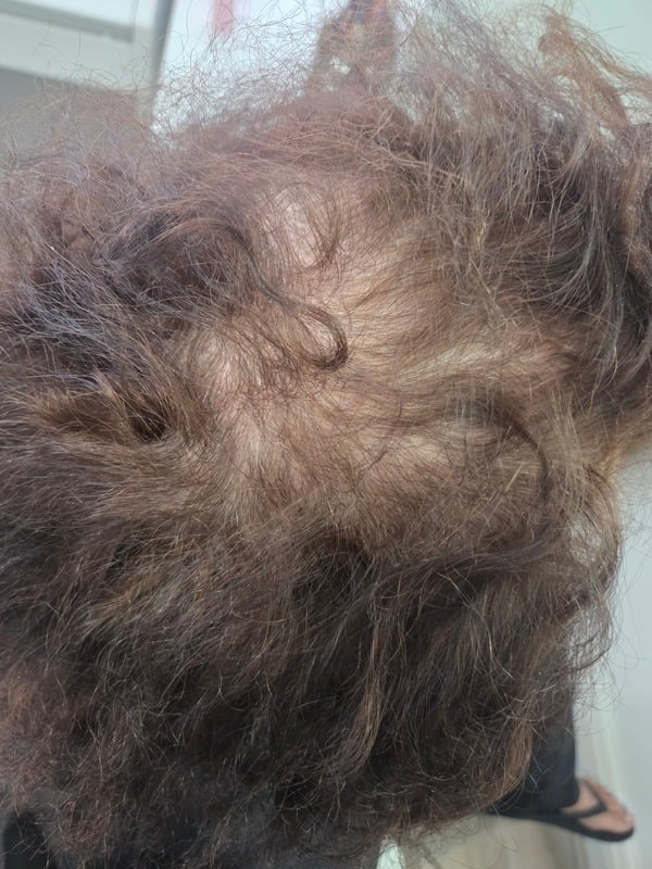 Before: sparse regrowth after chemotherapy