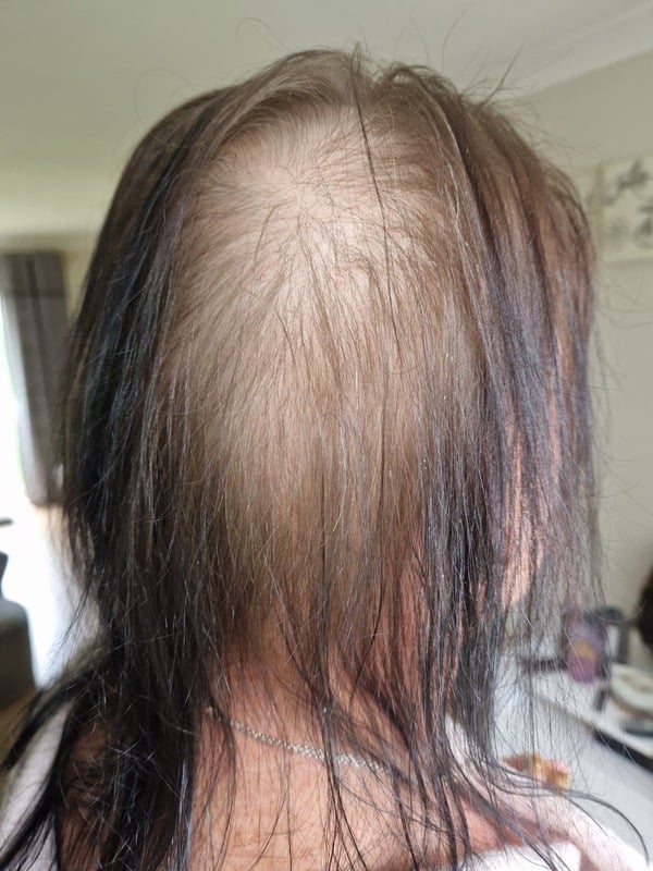 Before: diffuse thinning at the crown and parting
