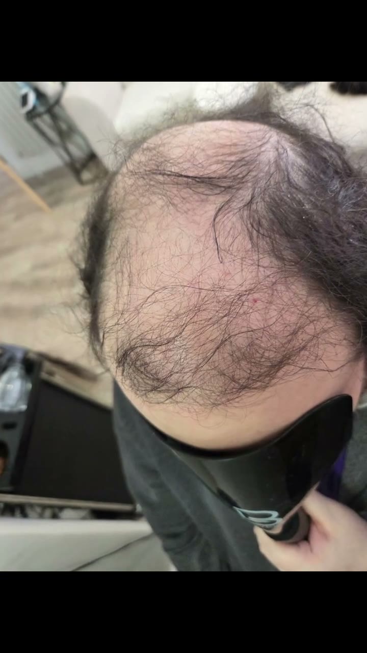 Before: thinning through the crown