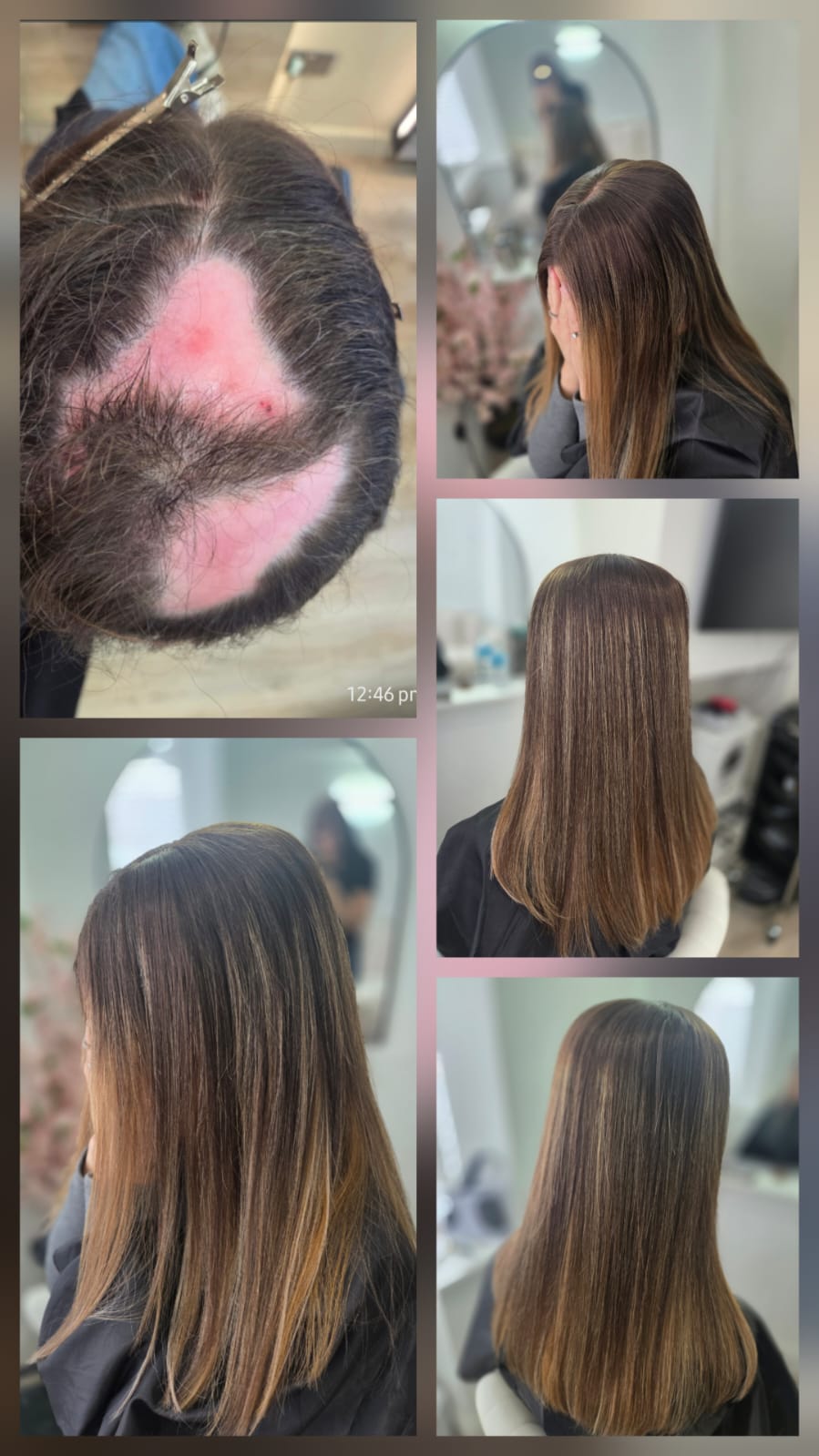 Before and after: an alopecia patch blended and covered with a mesh integration system